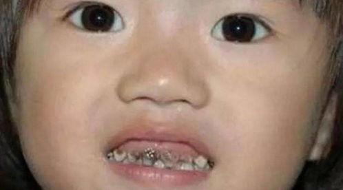 吃瓜下牙包上牙,揭秘下牙包上牙的奥秘